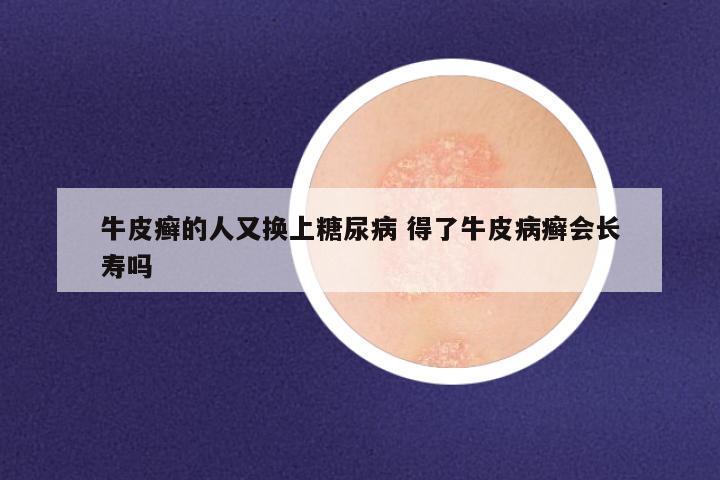 牛皮癣的人又换上糖尿病 得了牛皮病癣会长寿吗