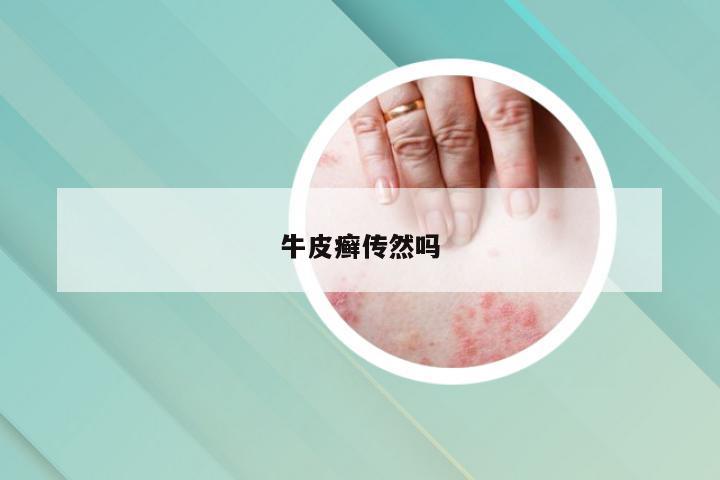牛皮癣传然吗