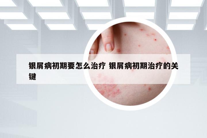 银屑病初期要怎么治疗 银屑病初期治疗的关键