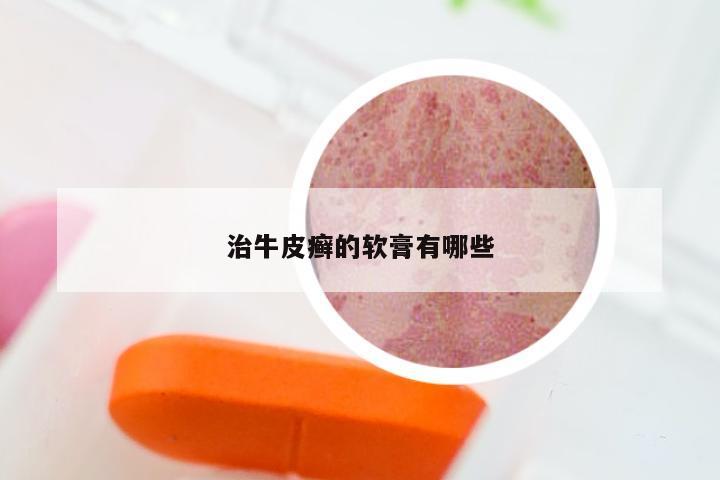 治牛皮癣的软膏有哪些
