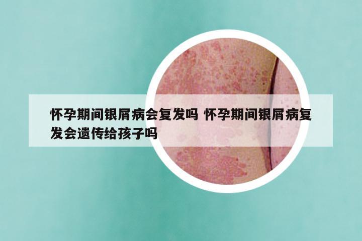 怀孕期间银屑病会复发吗 怀孕期间银屑病复发会遗传给孩子吗