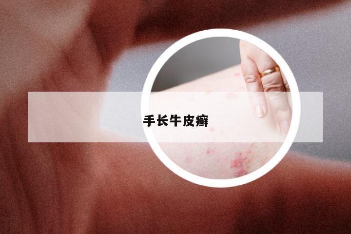 手长牛皮癣