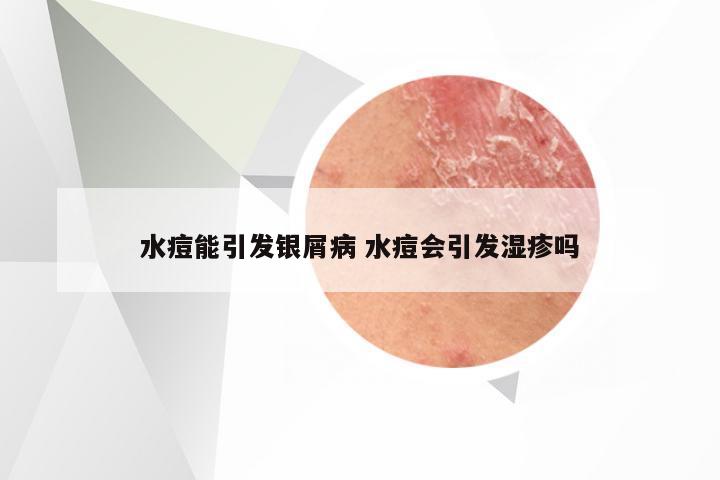 水痘能引发银屑病 水痘会引发湿疹吗