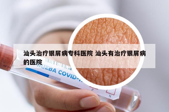 汕头治疗银屑病专科医院 汕头有治疗银屑病的医院