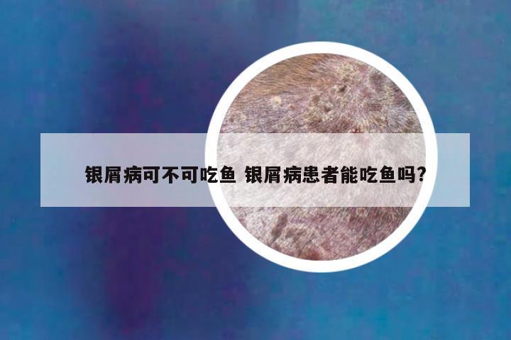 银屑病可不可吃鱼 银屑病患者能吃鱼吗?