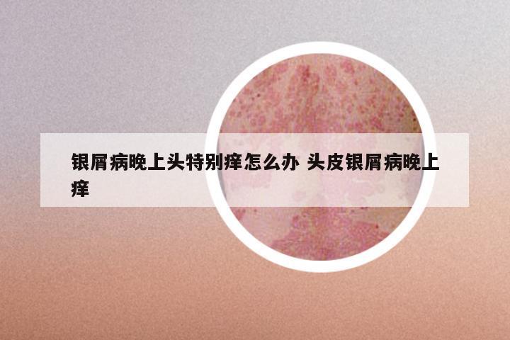 银屑病晚上头特别痒怎么办 头皮银屑病晚上痒