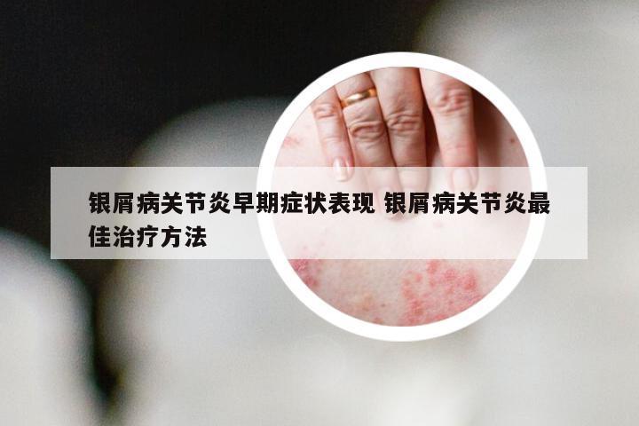 银屑病关节炎早期症状表现 银屑病关节炎最佳治疗方法