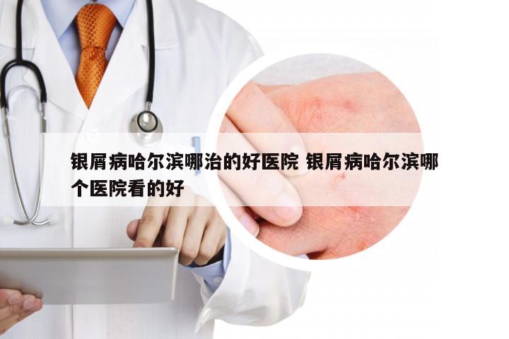 银屑病哈尔滨哪治的好医院 银屑病哈尔滨哪个医院看的好