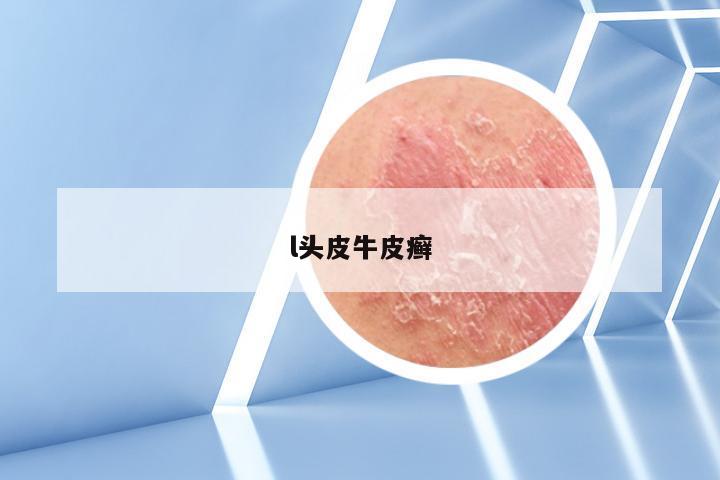 l头皮牛皮癣