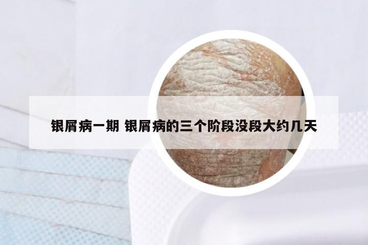 银屑病一期 银屑病的三个阶段没段大约几天