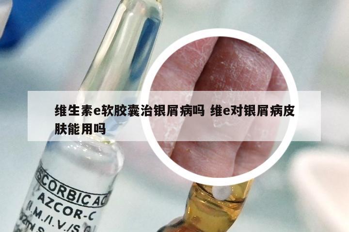 维生素e软胶囊治银屑病吗 维e对银屑病皮肤能用吗