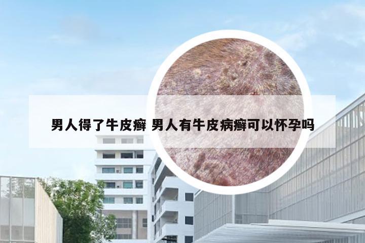 男人得了牛皮癣 男人有牛皮病癣可以怀孕吗