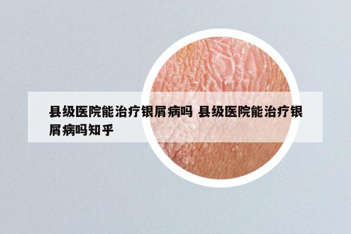 县级医院能治疗银屑病吗 县级医院能治疗银屑病吗知乎