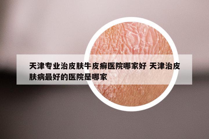 天津专业治皮肤牛皮癣医院哪家好 天津治皮肤病最好的医院是哪家