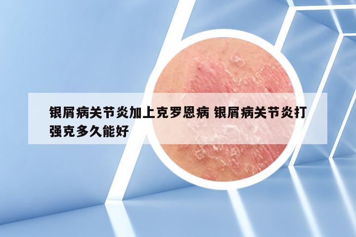 银屑病关节炎加上克罗恩病 银屑病关节炎打强克多久能好
