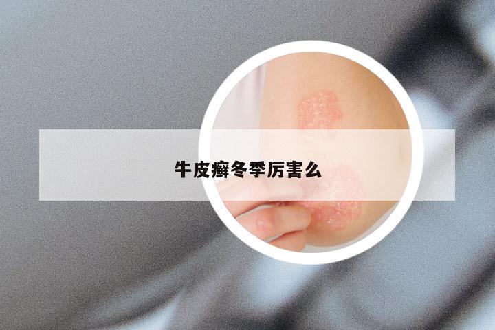 牛皮癣冬季厉害么