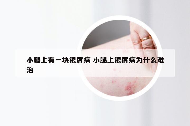 小腿上有一块银屑病 小腿上银屑病为什么难治