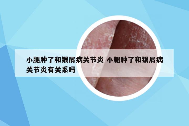 小腿肿了和银屑病关节炎 小腿肿了和银屑病关节炎有关系吗