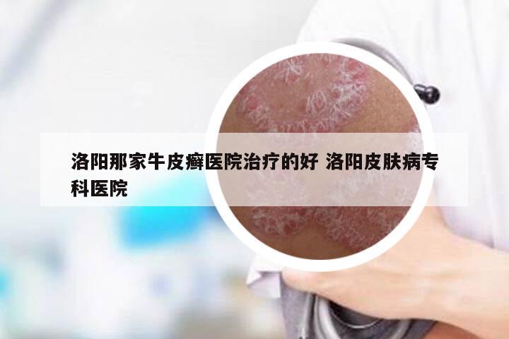 洛阳那家牛皮癣医院治疗的好 洛阳皮肤病专科医院