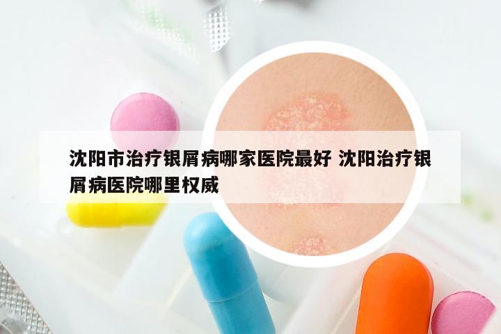 沈阳市治疗银屑病哪家医院最好 沈阳治疗银屑病医院哪里权威
