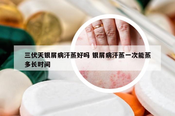 三伏天银屑病汗蒸好吗 银屑病汗蒸一次能蒸多长时间