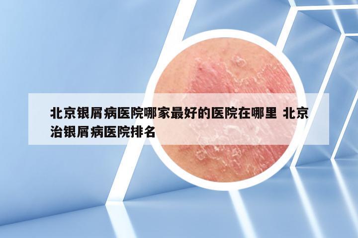 北京银屑病医院哪家最好的医院在哪里 北京治银屑病医院排名