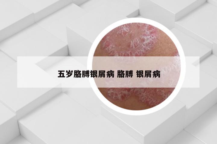 五岁胳膊银屑病 胳膊 银屑病