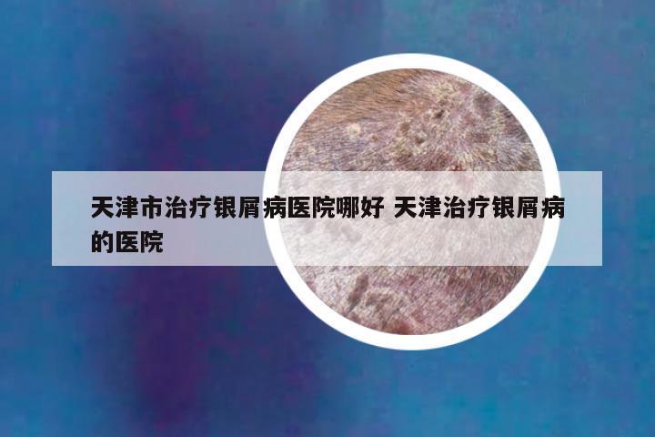 天津市治疗银屑病医院哪好 天津治疗银屑病的医院