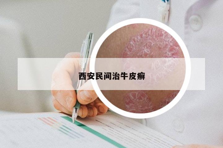 西安民间治牛皮癣