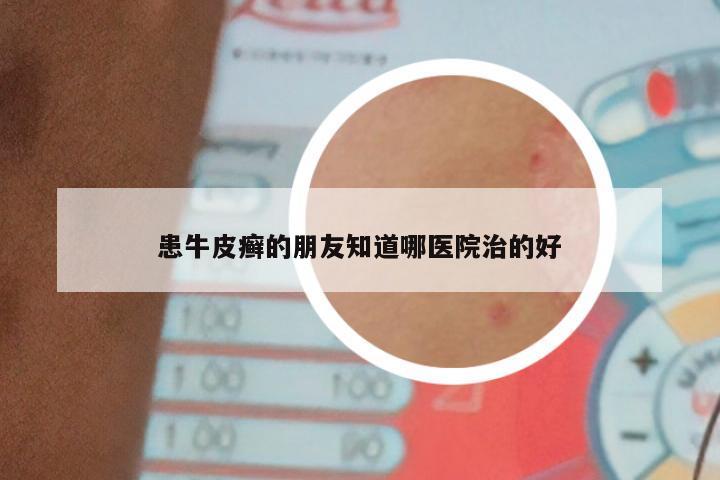 患牛皮癣的朋友知道哪医院治的好