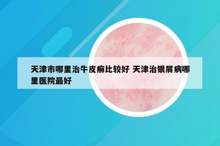 天津市哪里治牛皮癣比较好 天津治银屑病哪里医院最好