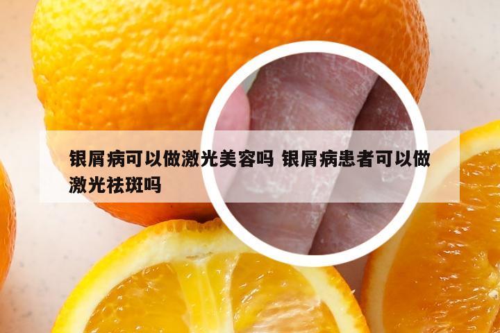 银屑病可以做激光美容吗 银屑病患者可以做激光祛斑吗