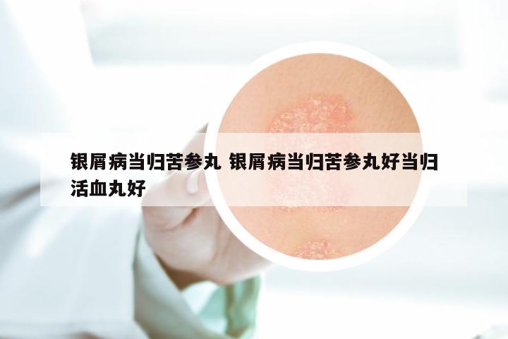 银屑病当归苦参丸 银屑病当归苦参丸好当归活血丸好