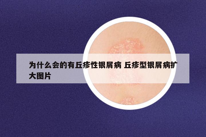 为什么会的有丘疹性银屑病 丘疹型银屑病扩大图片