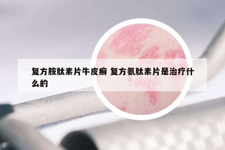 复方胺肽素片牛皮癣 复方氨肽素片是治疗什么的