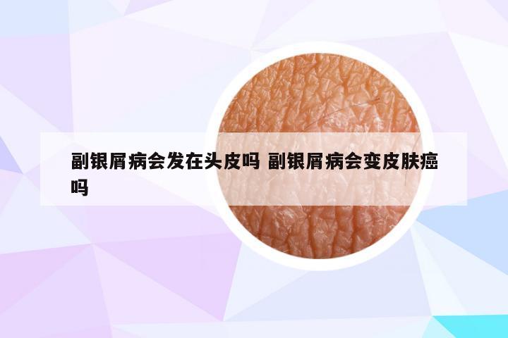 副银屑病会发在头皮吗 副银屑病会变皮肤癌吗