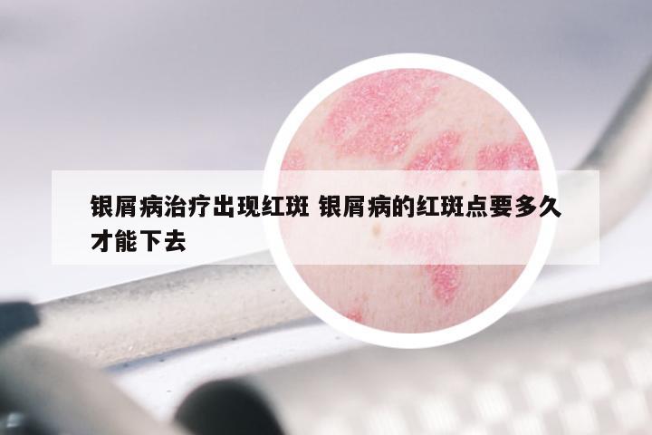 银屑病治疗出现红斑 银屑病的红斑点要多久才能下去