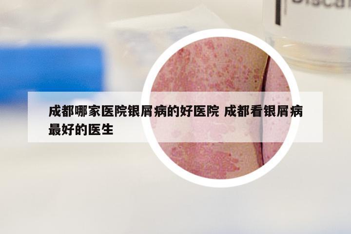 成都哪家医院银屑病的好医院 成都看银屑病最好的医生
