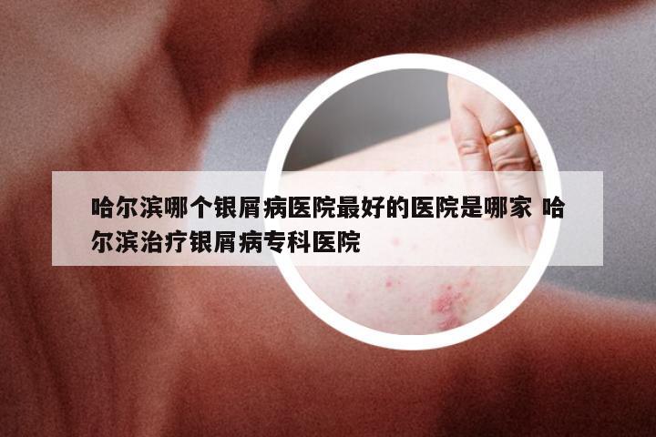 哈尔滨哪个银屑病医院最好的医院是哪家 哈尔滨治疗银屑病专科医院