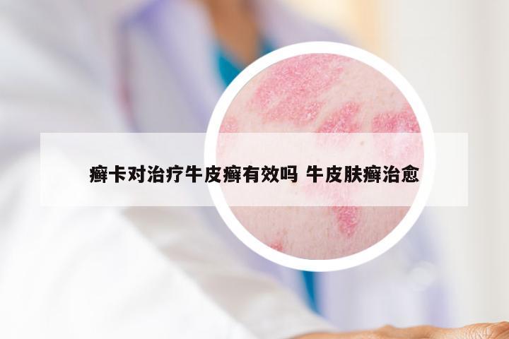 癣卡对治疗牛皮癣有效吗 牛皮肤癣治愈