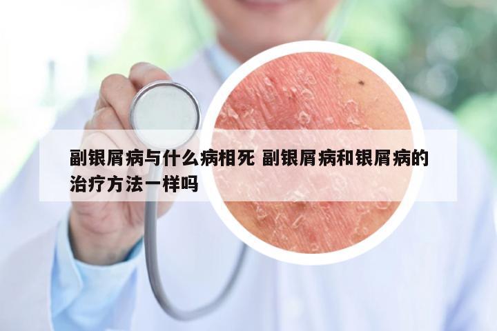 副银屑病与什么病相死 副银屑病和银屑病的治疗方法一样吗