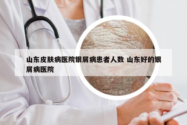 山东皮肤病医院银屑病患者人数 山东好的银屑病医院