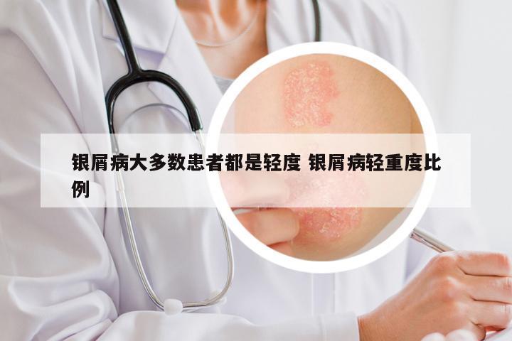 银屑病大多数患者都是轻度 银屑病轻重度比例
