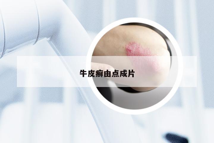 牛皮癣由点成片
