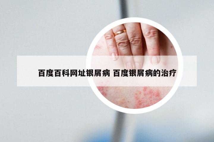 百度百科网址银屑病 百度银屑病的治疗