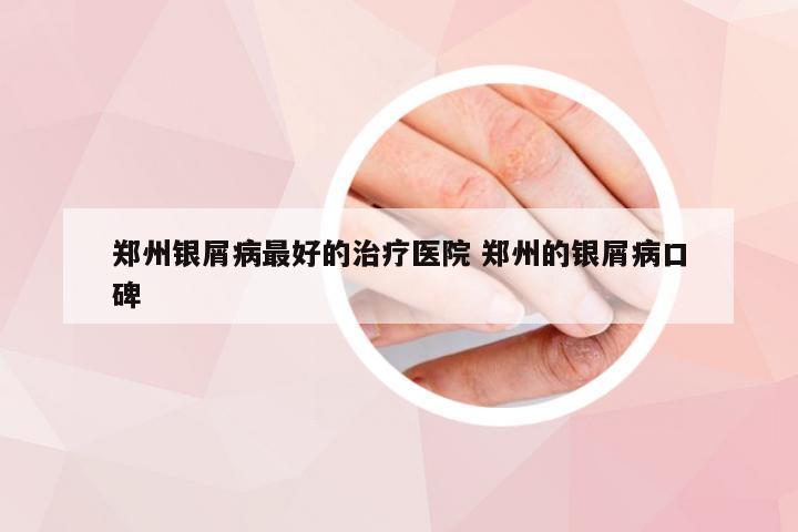 郑州银屑病最好的治疗医院 郑州的银屑病口碑