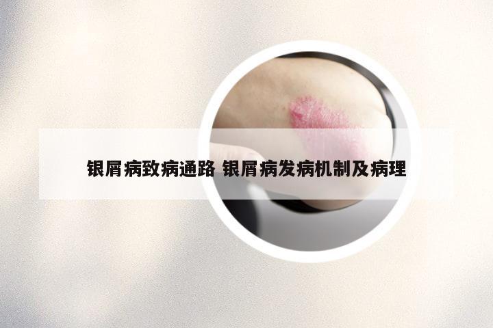 银屑病致病通路 银屑病发病机制及病理