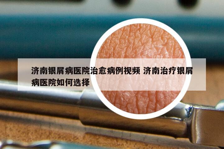 济南银屑病医院治愈病例视频 济南治疗银屑病医院如何选择