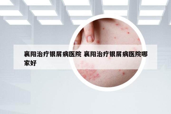 襄阳治疗银屑病医院 襄阳治疗银屑病医院哪家好