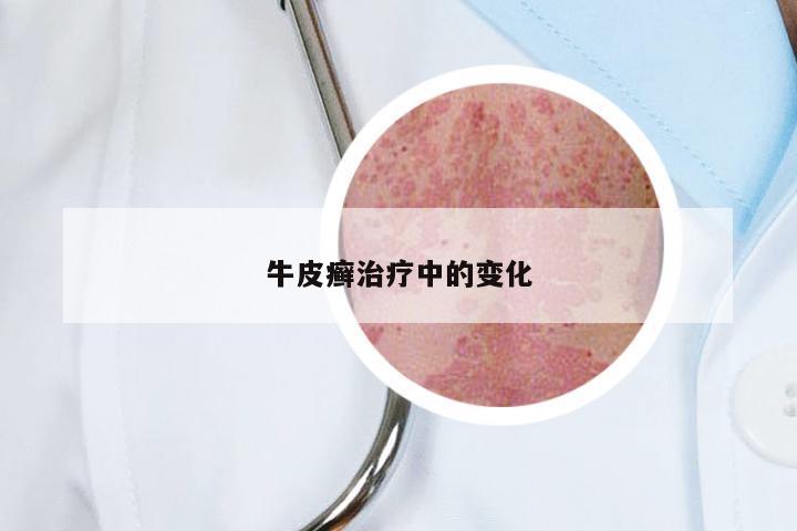 牛皮癣治疗中的变化